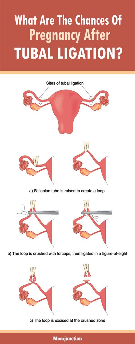 how likely am i to get pregnant after tubal ligation