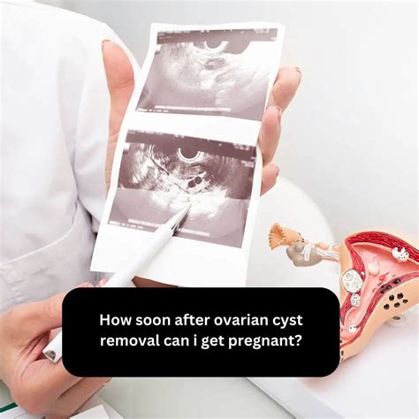 how long to wait to get pregnant after ovarian cyst removal