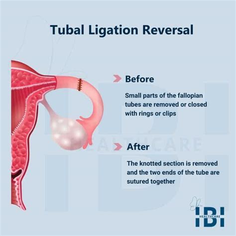 how to get pregnant after tubal ligation reversal