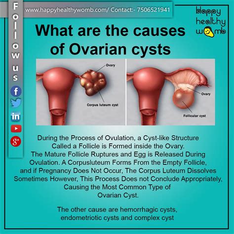 how to get pregnant faster with ovarian cyst
