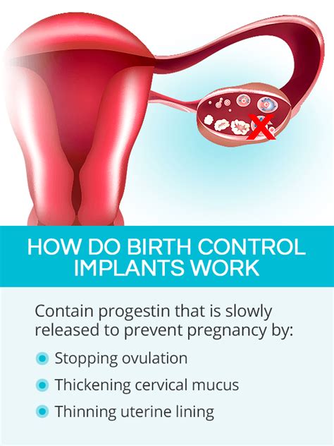 how to get pregnant on the implant